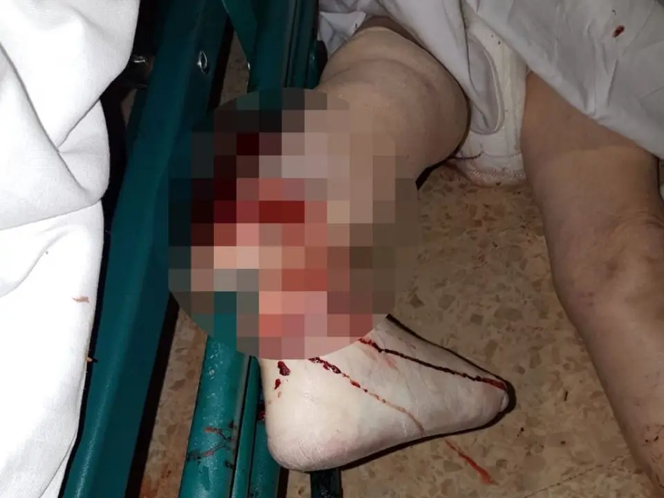Imagen de la pierna de la fallecida (Cadena SER).