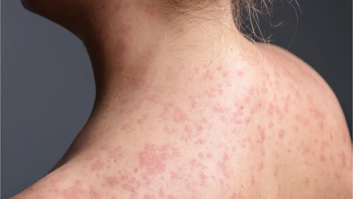Erupci&oacute;n cut&aacute;nea caracter&iacute;stica del sarampi&oacute;n en un paciente. SHUTTERSTOCK