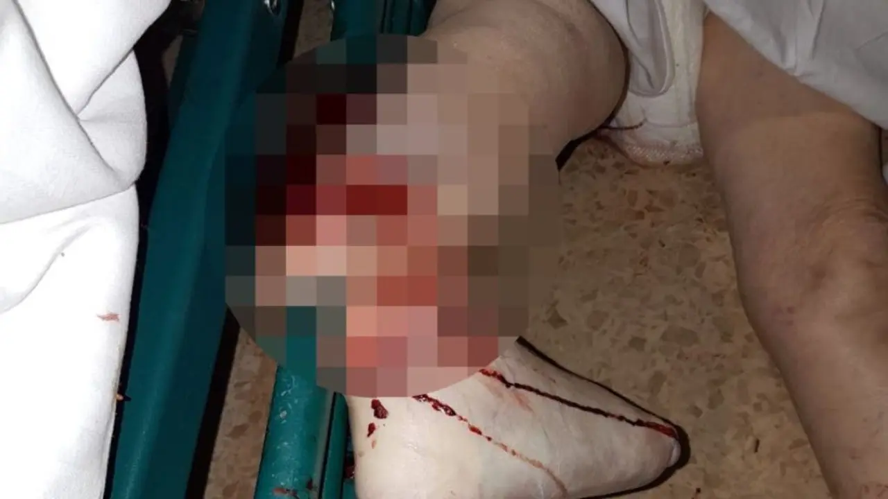 Imagen de la pierna de la fallecida (Cadena SER).