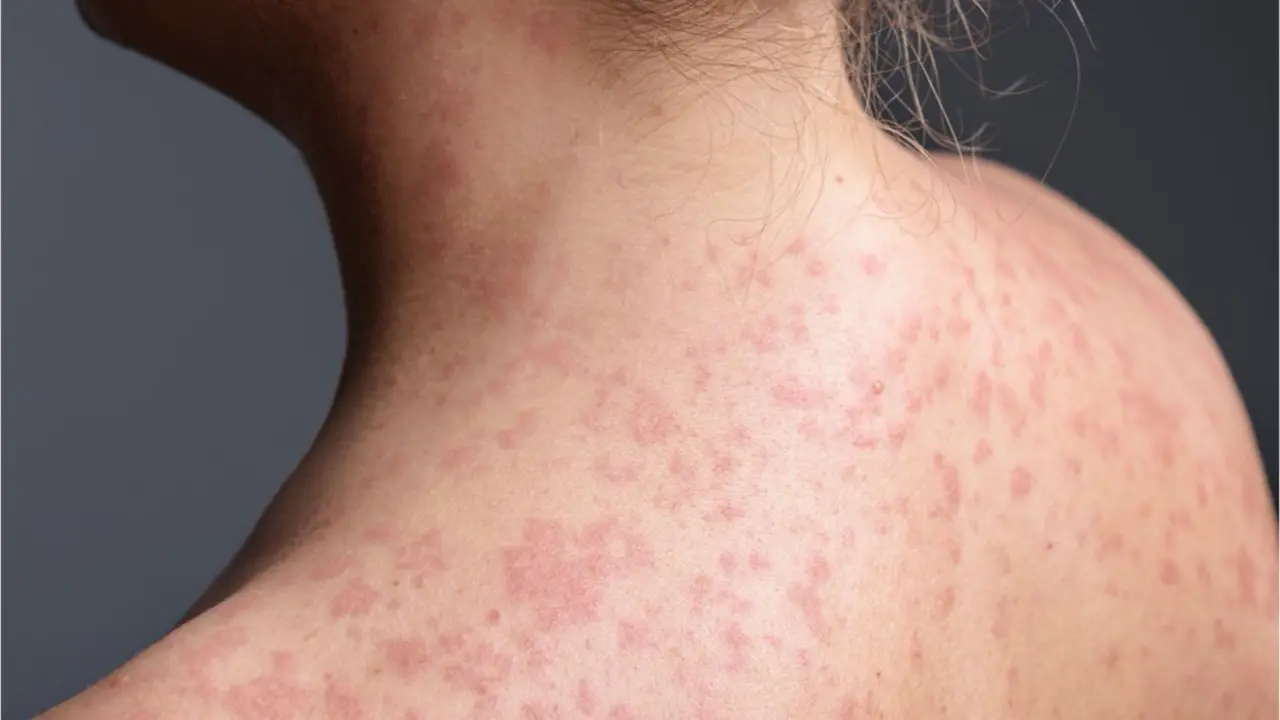 Erupci&oacute;n cut&aacute;nea caracter&iacute;stica del sarampi&oacute;n en un paciente. SHUTTERSTOCK