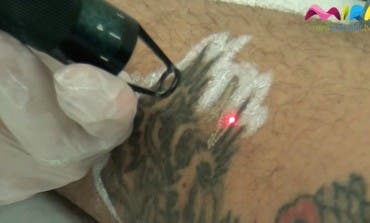 Video- Te contamos cómo eliminar tus tatuajes en Alcalá de Henares