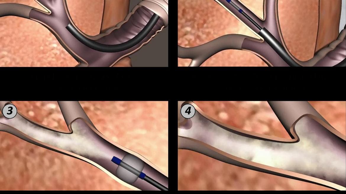 El Gregorio Marañón implanta una técnica pionera contra el enfisema pulmonar severo