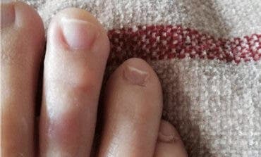 Un dermatólogo de Alcalá de Henares analiza las manifestaciones cutáneas del coronavirus