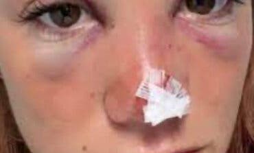 Buscan al conductor que arrolló en Madrid a una exconcursante de MasterChef cuando iba en moto y se dio a la fuga