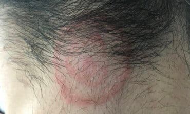 Los dermatólogos alertan del brote de tiña detectado en peluquerías de toda España 
