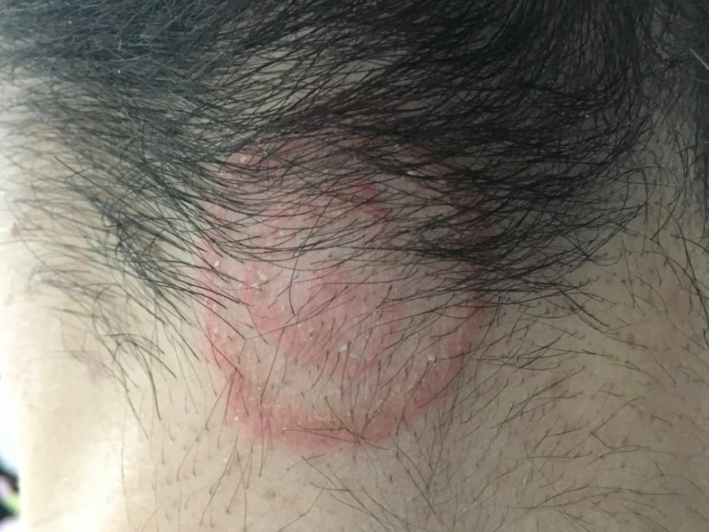 Los dermatólogos alertan del brote de tiña detectado en peluquerías de toda España 